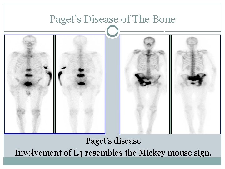 Paget’s Disease of The Bone Paget’s disease Involvement of L 4 resembles the Mickey