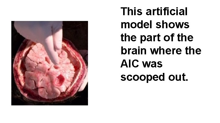 This artificial model shows the part of the brain where the AIC was scooped