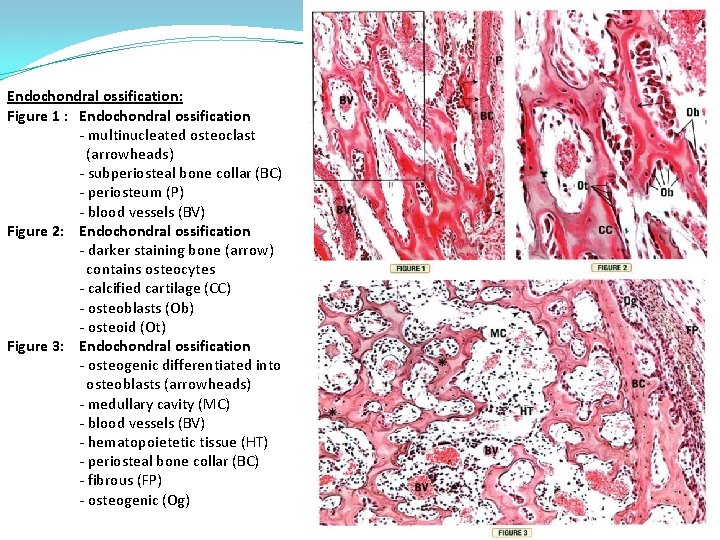 Endochondral ossification: Figure 1 : Endochondral ossification - multinucleated osteoclast (arrowheads) - subperiosteal bone