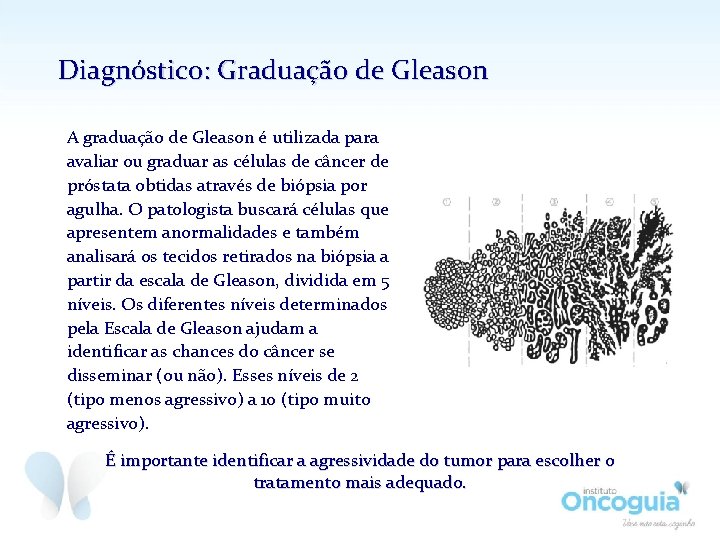 Diagnóstico: Graduação de Gleason A graduação de Gleason é utilizada para avaliar ou graduar