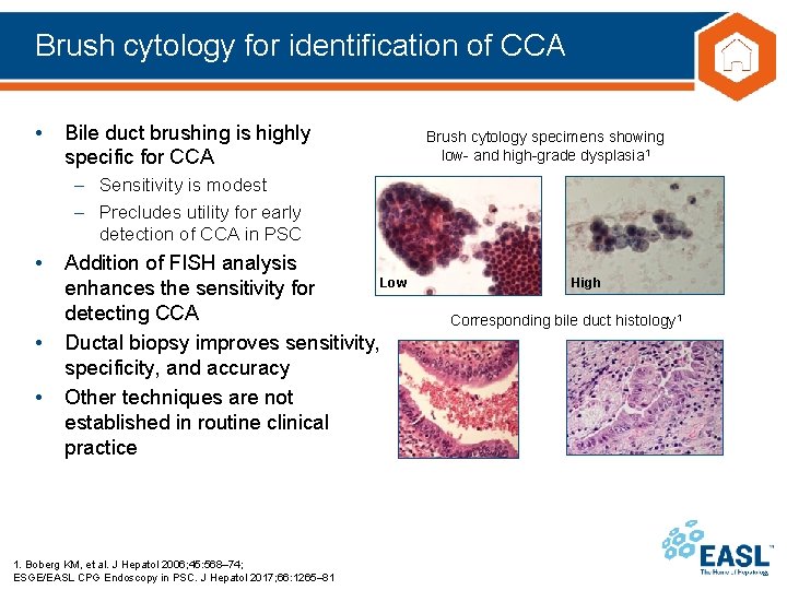 Brush cytology for identification of CCA • Bile duct brushing is highly specific for