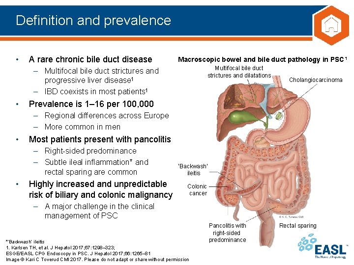 Definition and prevalence • A rare chronic bile duct disease Macroscopic bowel and bile