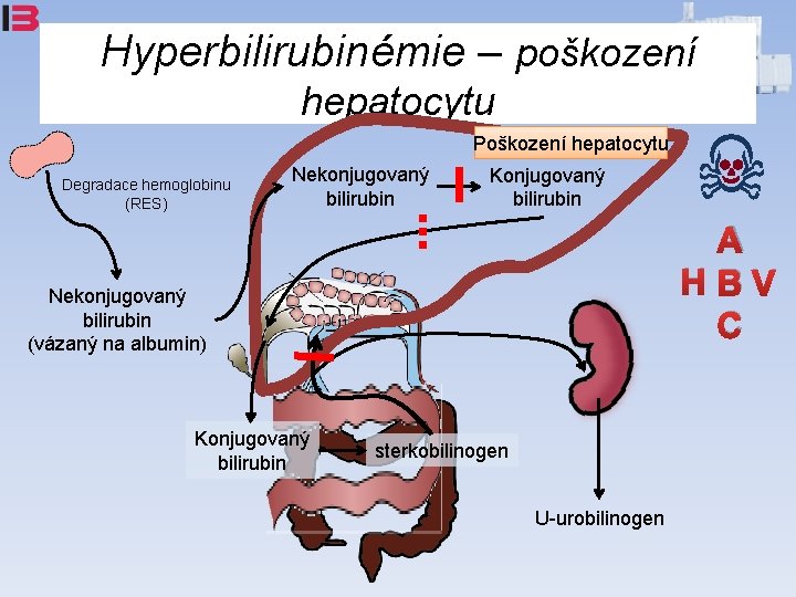 Hyperbilirubinémie – poškození hepatocytu Poškození hepatocytu Degradace hemoglobinu (RES) Nekonjugovaný bilirubin Konjugovaný bilirubin A