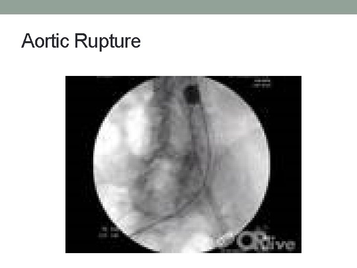 Aortic Rupture 