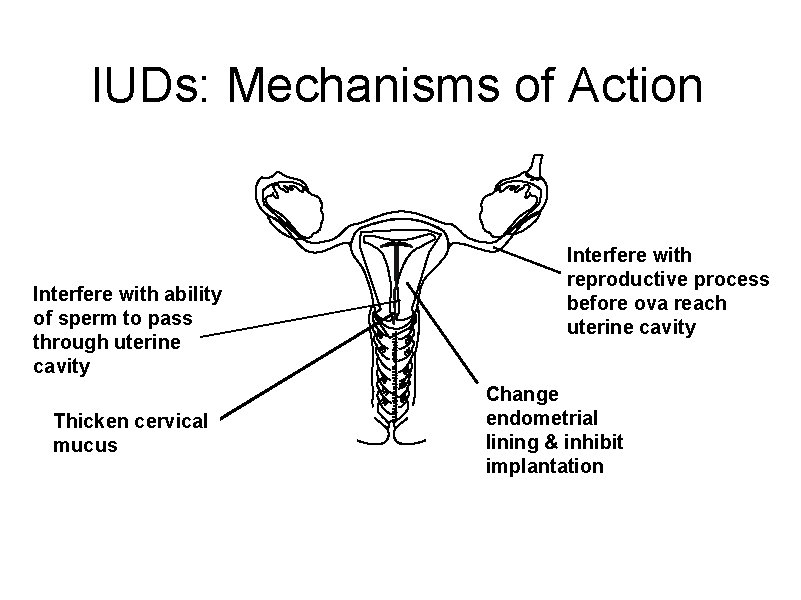 IUDs: Mechanisms of Action Interfere with ability of sperm to pass through uterine cavity