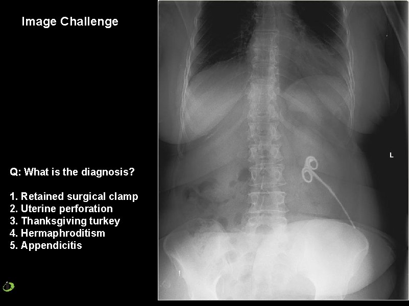 Image Challenge Q: What is the diagnosis? 1. Retained surgical clamp 2. Uterine perforation
