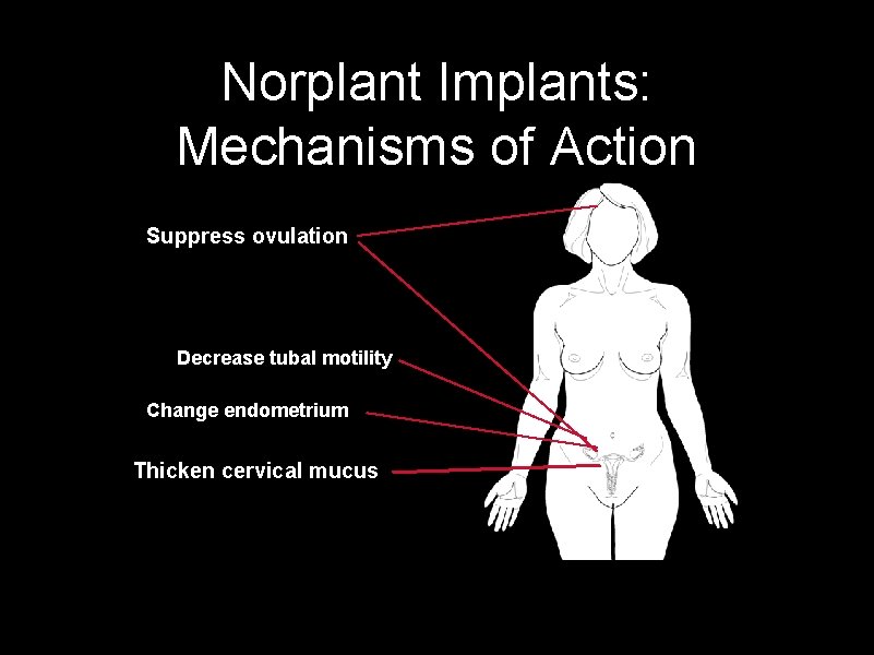 Norplant Implants: Mechanisms of Action Suppress ovulation Decrease tubal motility Change endometrium Thicken cervical