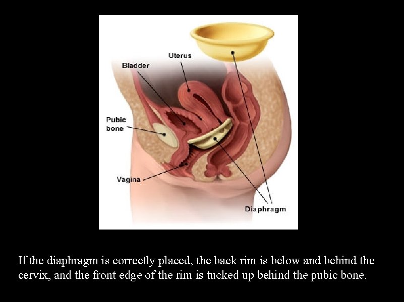 If the diaphragm is correctly placed, the back rim is below and behind the