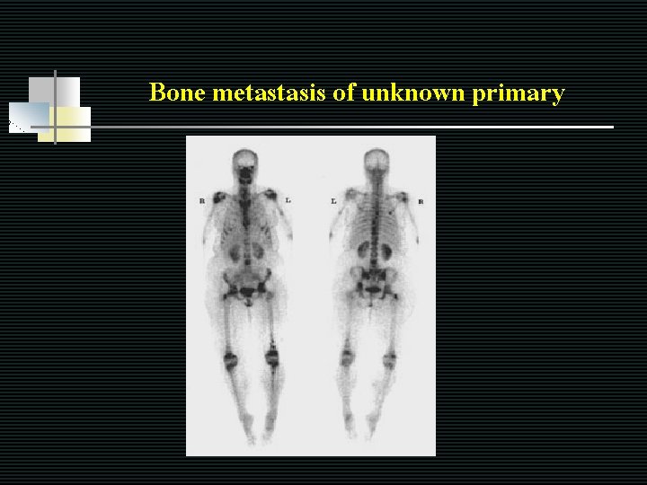 Bone metastasis of unknown primary 