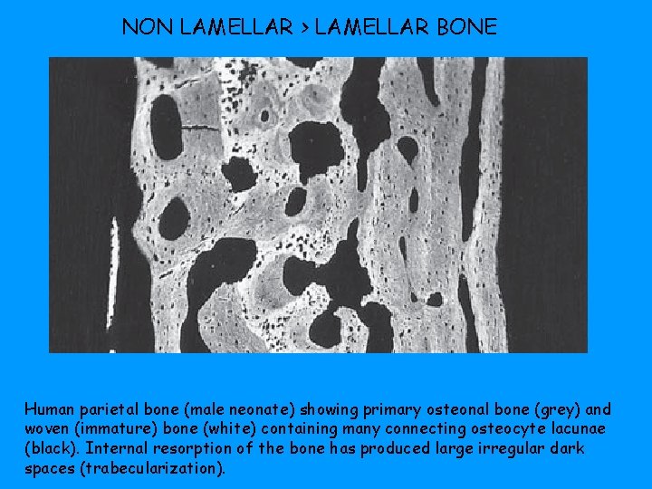 NON LAMELLAR > LAMELLAR BONE Human parietal bone (male neonate) showing primary osteonal bone