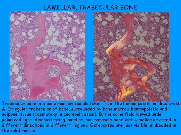 LAMELLAR, TRABECULAR BONE Trabecular bone in a bone marrow sample taken from the human