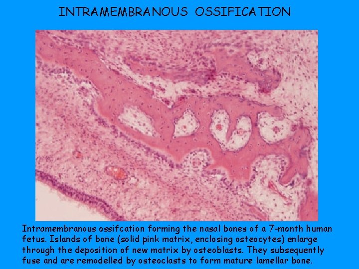 INTRAMEMBRANOUS OSSIFICATION Intramembranous ossifcation forming the nasal bones of a 7 -month human fetus.
