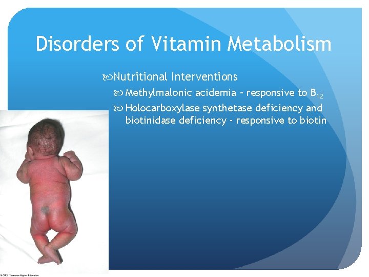 Disorders of Vitamin Metabolism Nutritional Interventions Methylmalonic acidemia – responsive to B 12 Holocarboxylase