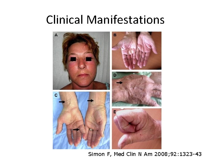 Clinical Manifestations Simon F, Med Clin N Am 2008; 92: 1323 -43 