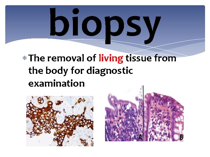 biopsy The removal of living tissue from the body for diagnostic examination 