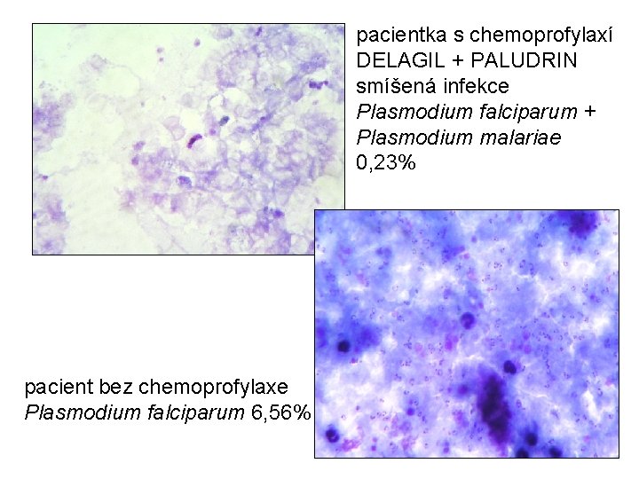 pacientka s chemoprofylaxí DELAGIL + PALUDRIN smíšená infekce Plasmodium falciparum + Plasmodium malariae 0,