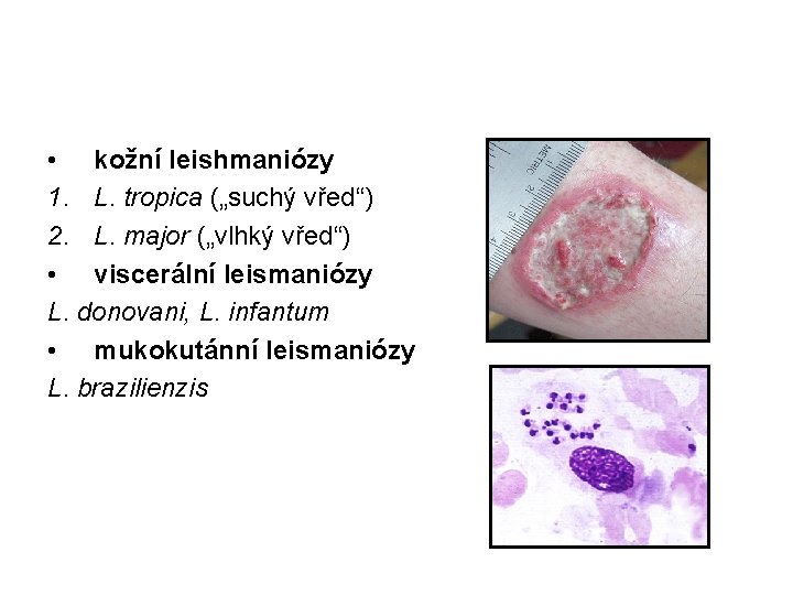  • kožní leishmaniózy 1. L. tropica („suchý vřed“) 2. L. major („vlhký vřed“)