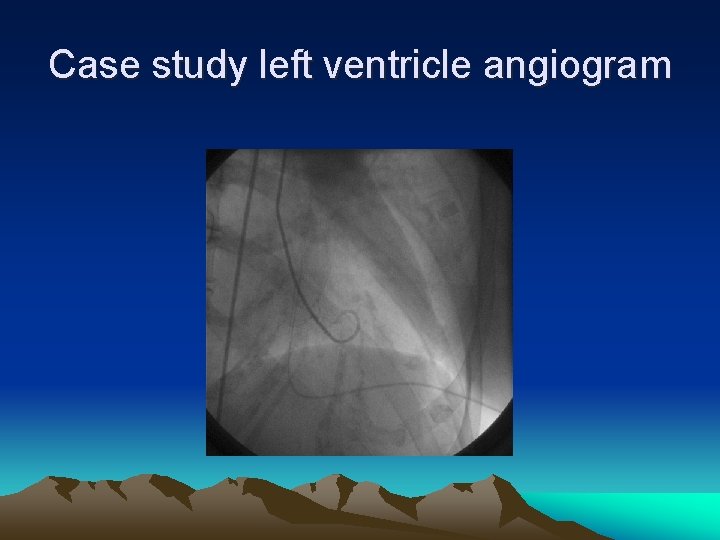 Case study left ventricle angiogram 
