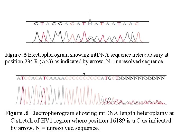 Figure. 5 Electropherogram showing mt. DNA sequence heteroplasmy at position 234 R (A/G) as