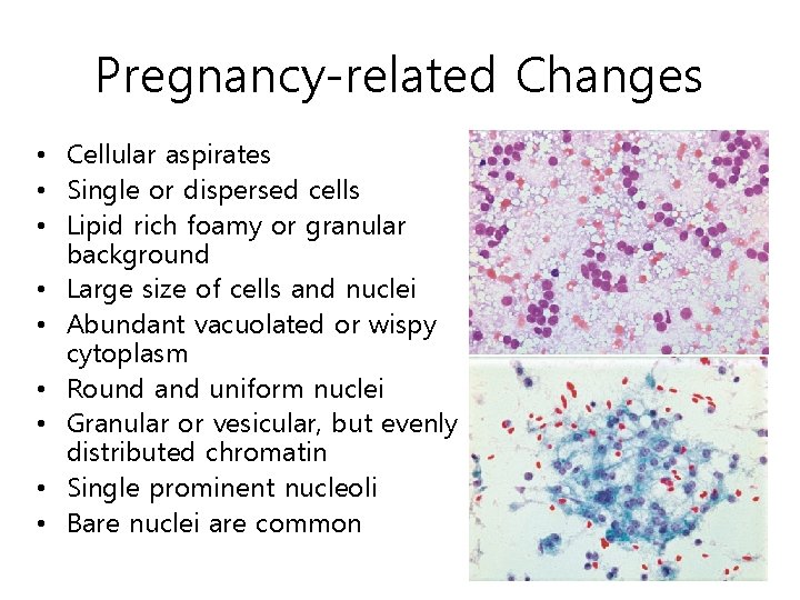 Pregnancy-related Changes • Cellular aspirates • Single or dispersed cells • Lipid rich foamy