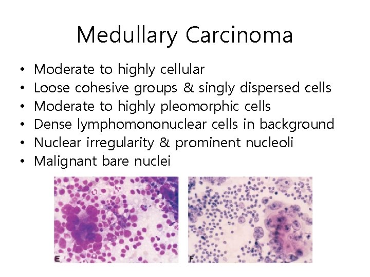 Medullary Carcinoma • • • Moderate to highly cellular Loose cohesive groups & singly