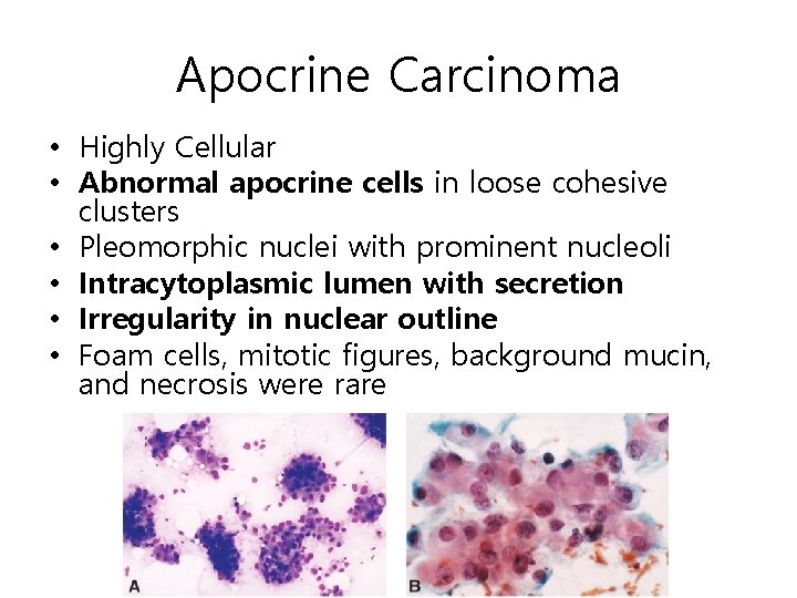 Apocrine Carcinoma • Highly Cellular • Abnormal apocrine cells in loose cohesive clusters •