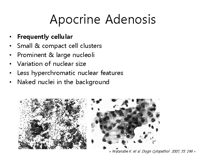 Apocrine Adenosis • • • Frequently cellular Small & compact cell clusters Prominent &