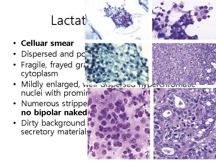 Lactating adenoma • Celluar smear • Dispersed and poorly cohesive clusters • Fragile, frayed