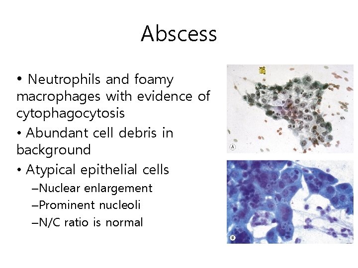 Abscess • Neutrophils and foamy macrophages with evidence of cytophagocytosis • Abundant cell debris
