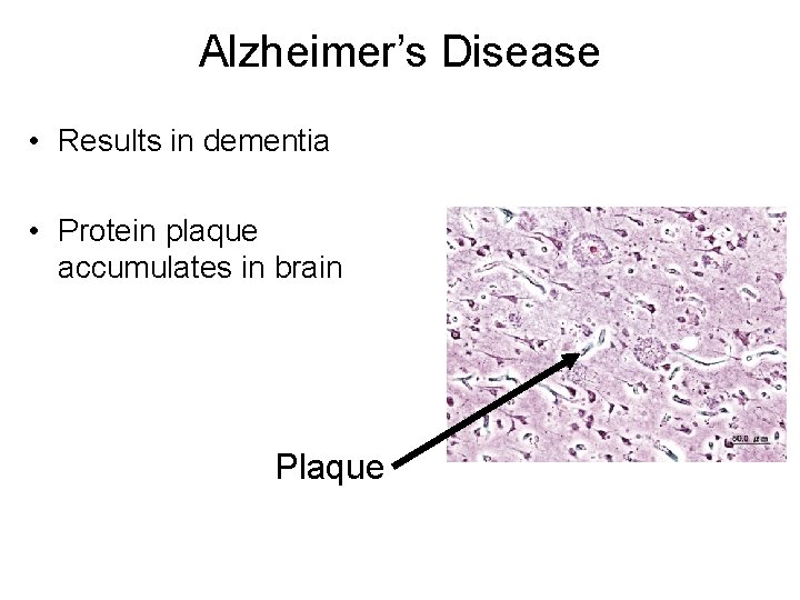 Alzheimer’s Disease • Results in dementia • Protein plaque accumulates in brain Plaque 