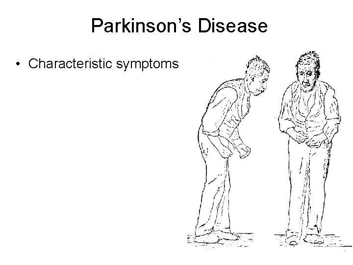 Parkinson’s Disease • Characteristic symptoms 