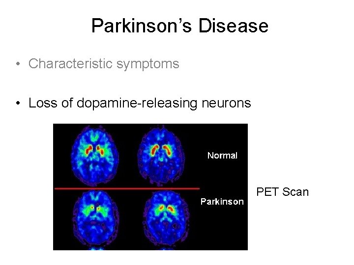 Parkinson’s Disease • Characteristic symptoms • Loss of dopamine-releasing neurons PET Scan Parkinson’s Disease • Characteristic symptoms • Loss of dopamine-releasing neurons PET Scan