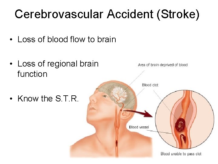 Cerebrovascular Accident (Stroke) • Loss of blood flow to brain • Loss of regional Cerebrovascular Accident (Stroke) • Loss of blood flow to brain • Loss of regional