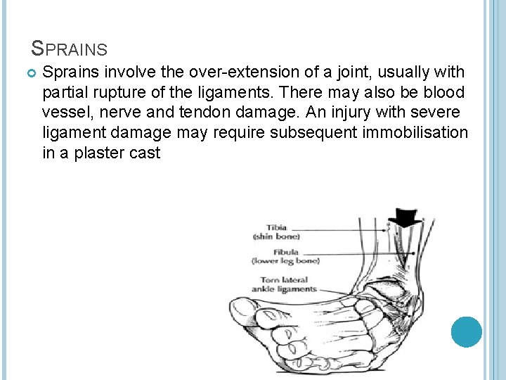 SPRAINS Sprains involve the over-extension of a joint, usually with partial rupture of the