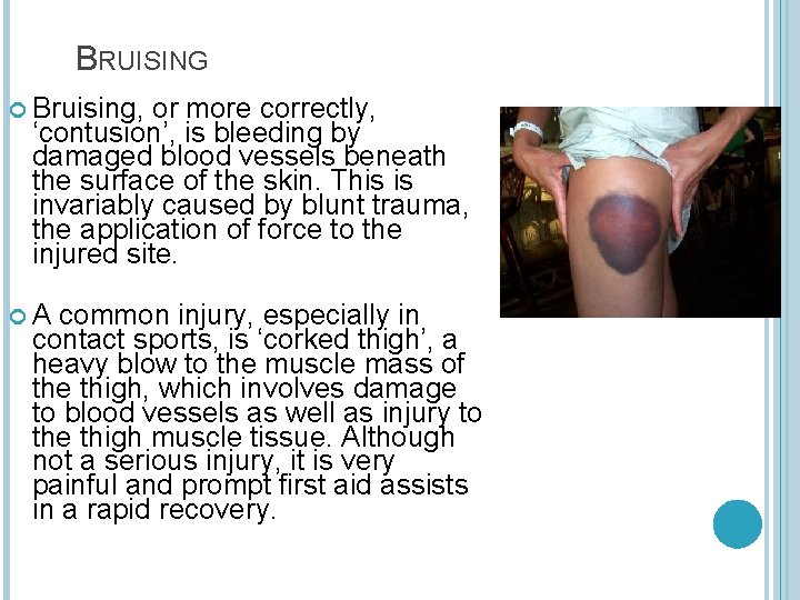 BRUISING Bruising, or more correctly, ‘contusion’, is bleeding by damaged blood vessels beneath the