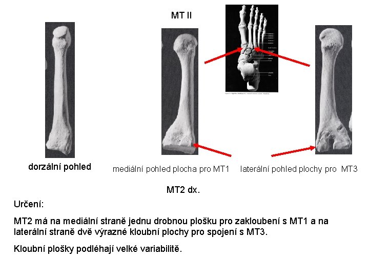 MT II dorzální pohled mediální pohled plocha pro MT 1 laterální pohled plochy pro