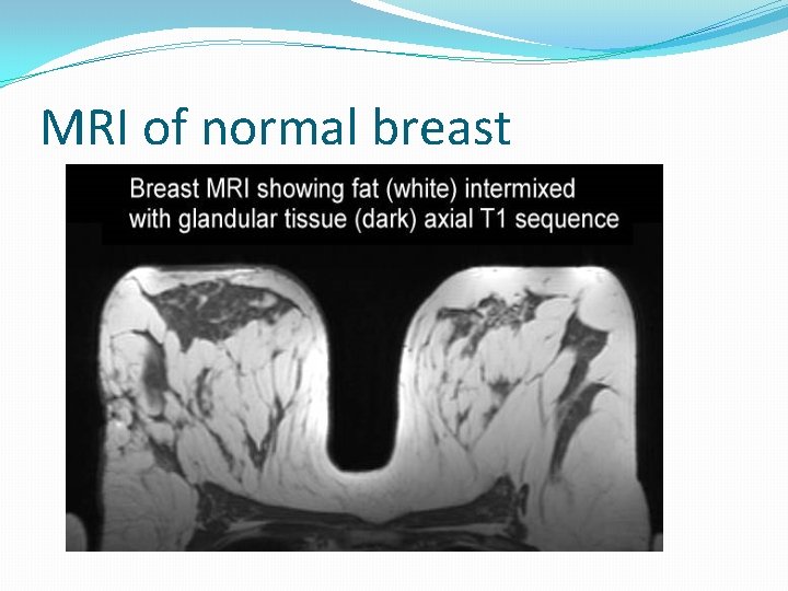 MRI of normal breast 