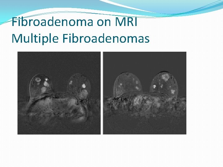 Fibroadenoma on MRI Multiple Fibroadenomas 