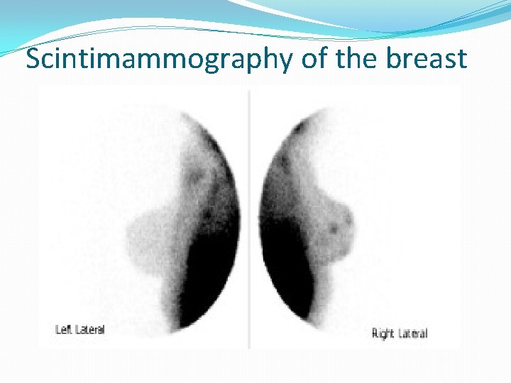 Scintimammography of the breast 