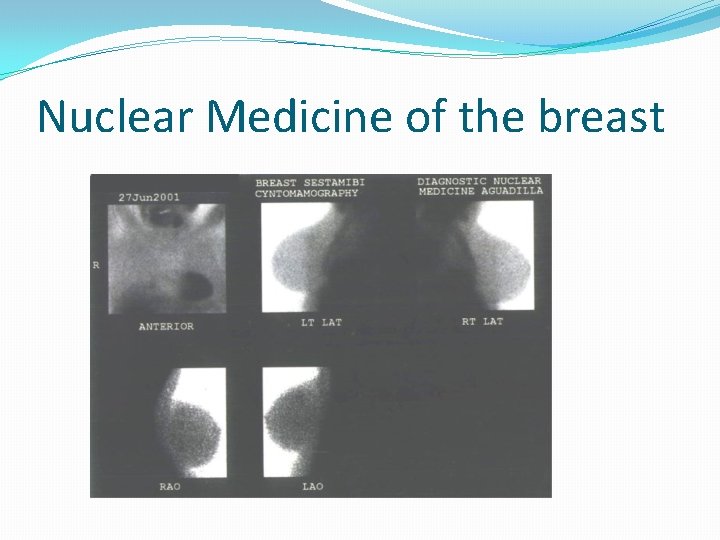 Nuclear Medicine of the breast 