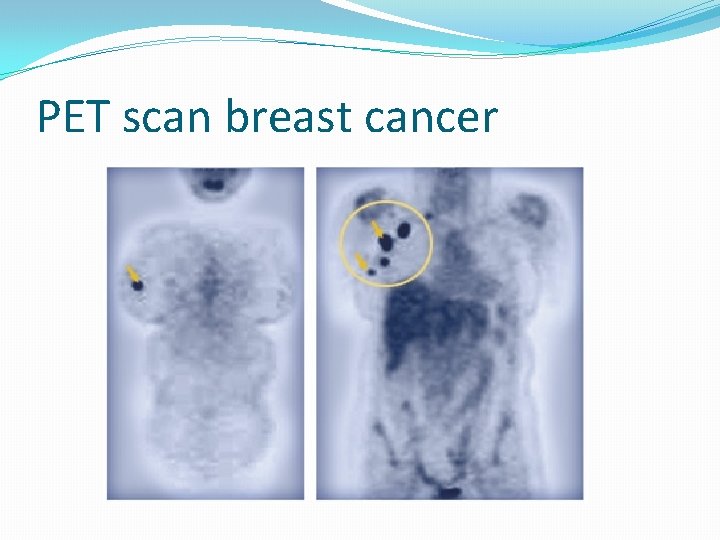 PET scan breast cancer 