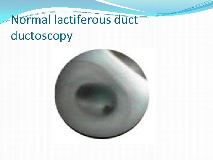 Normal lactiferous ductoscopy 
