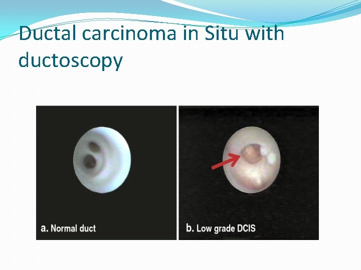 Ductal carcinoma in Situ with ductoscopy 