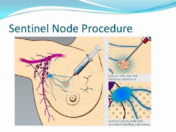 Sentinel Node Procedure 
