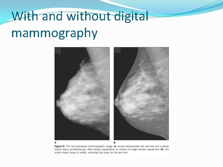 With and without digital mammography 