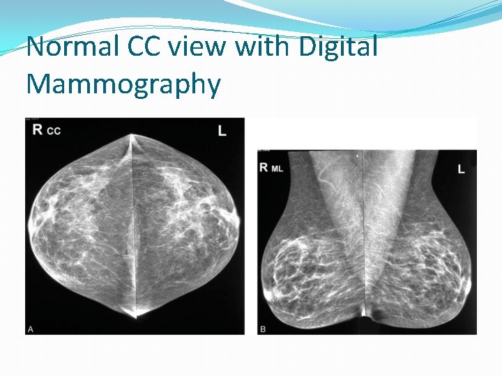 Normal CC view with Digital Mammography 