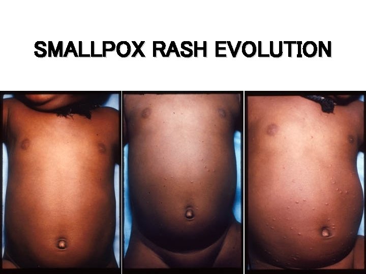 SMALLPOX RASH EVOLUTION Day 1 Day 2 Day 3 