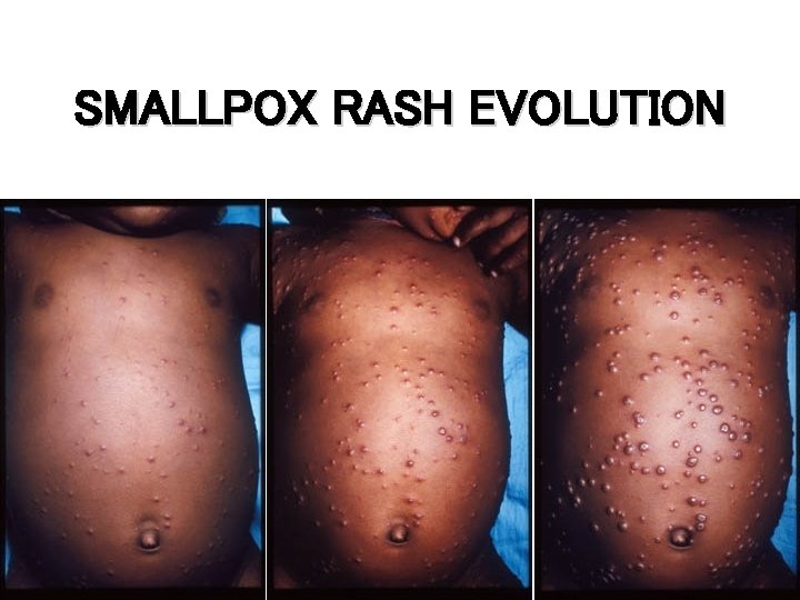 SMALLPOX RASH EVOLUTION Day 4 Day 5 Day 7 