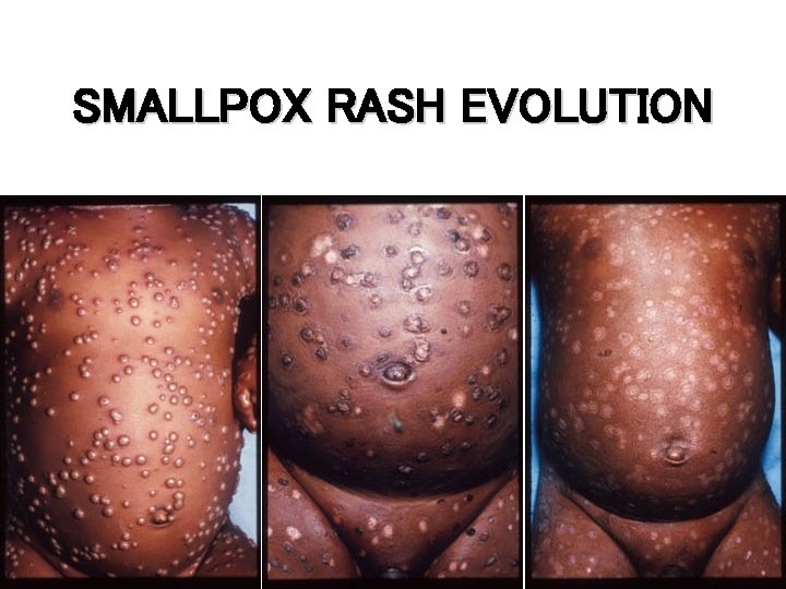 SMALLPOX RASH EVOLUTION Days 8 -9 20 Days 10 -14 Day 