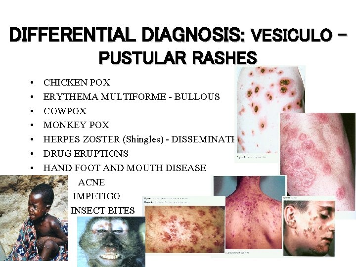 DIFFERENTIAL DIAGNOSIS: VESICULO – PUSTULAR RASHES • • • CHICKEN POX ERYTHEMA MULTIFORME -